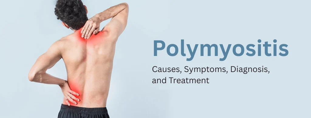 Polymyositis Treatment at IRIS