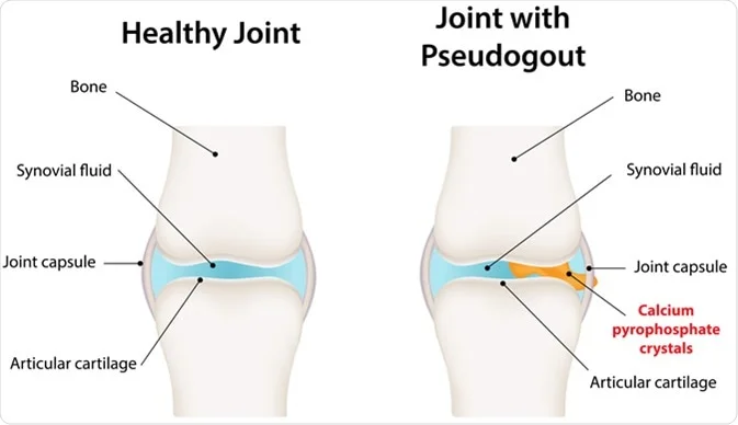 Gout and CPPD Arthropathy Treatment at IRIS