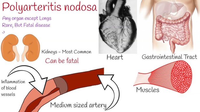 Polyarteritis Nodosa Treatment at IRIS