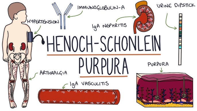 Henoch-Schonlein Purpura Treatment at IRIS