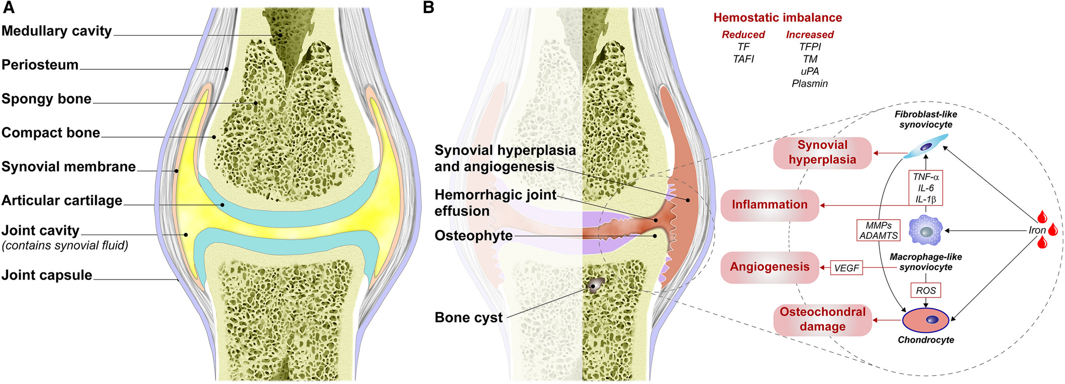 Hemophilic Arthropathy Treatment at IRIS