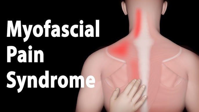 Myofascial Pain Syndromes Treatment at IRIS