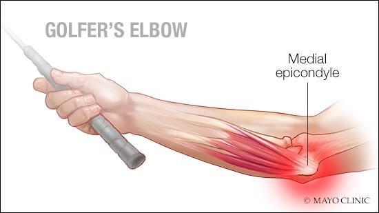 Medial Epicondylitis Treatment at IRIS