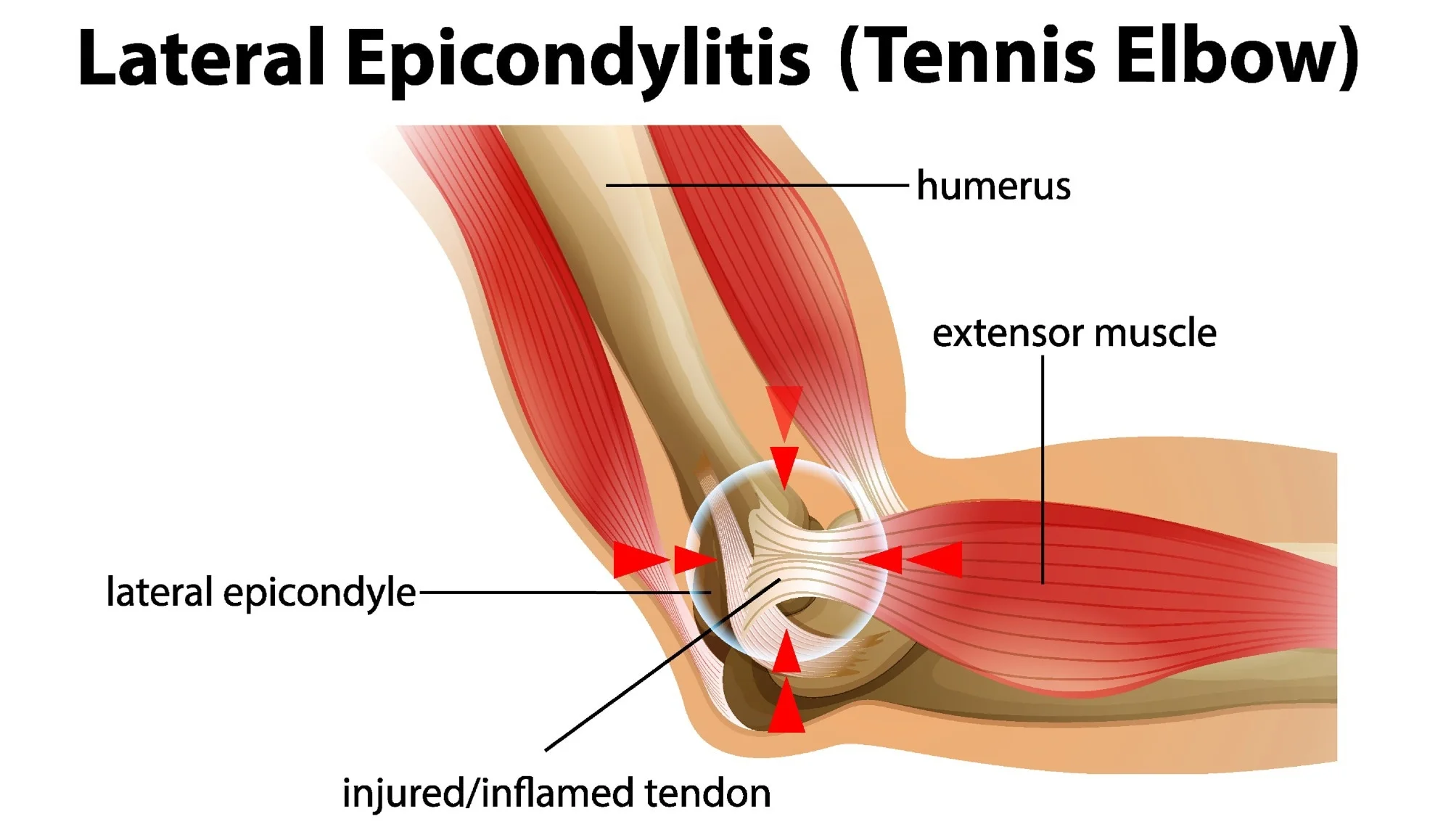 Lateral Epicondylitis Treatment at IRIS