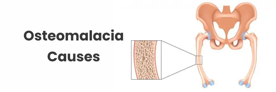 Osteomalacia Treatment at IRIS