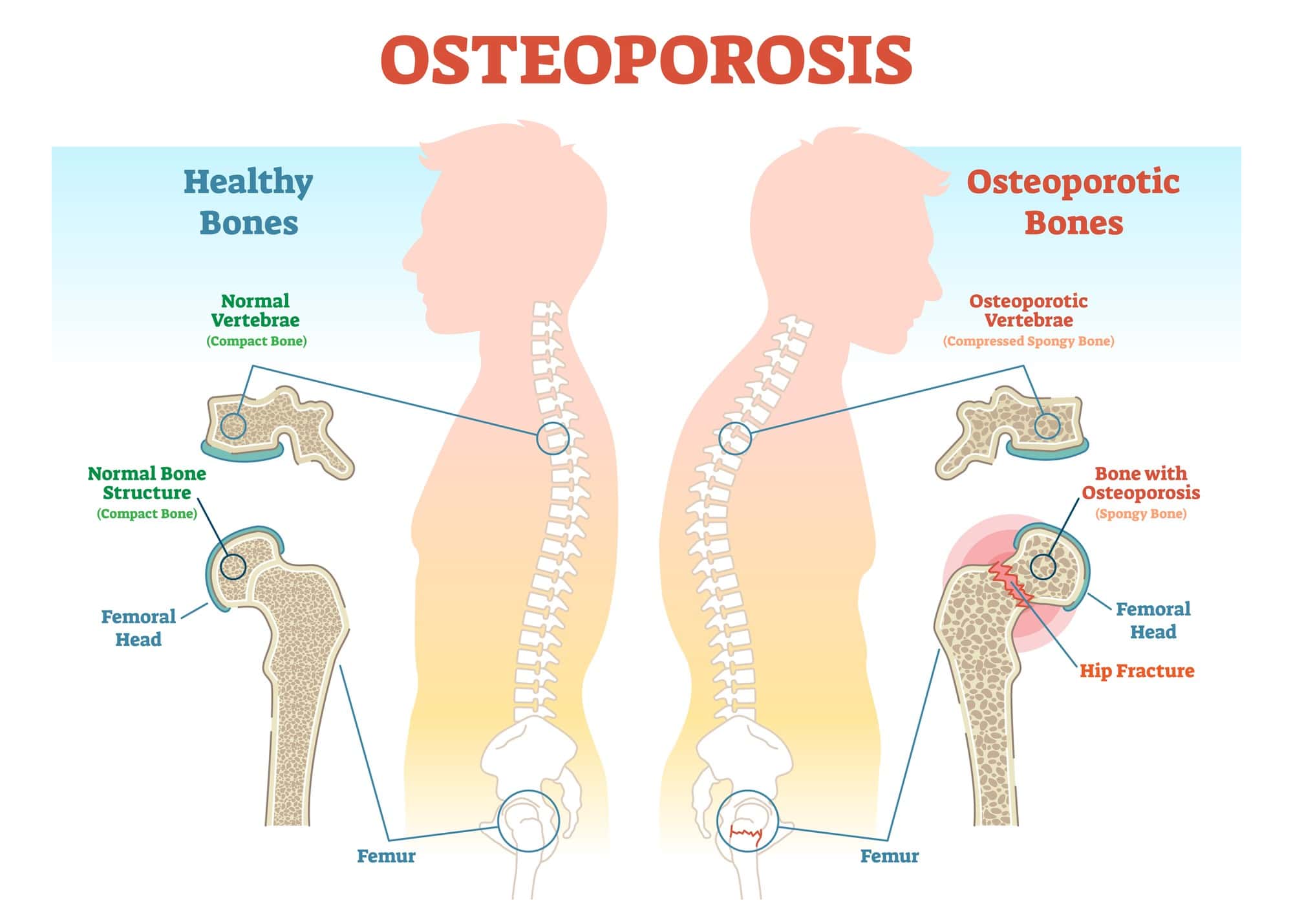 Osteoporosis Treatment at IRIS