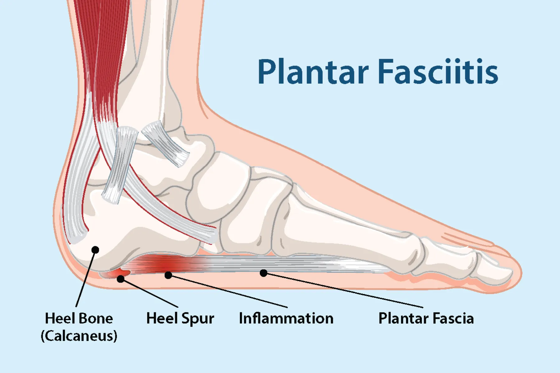 Plantar Fasciitis Treatment at IRIS