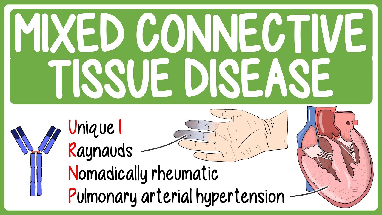 Mixed Connective Tissue Diseases Treatment at IRIS