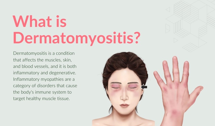 Dermatomyositis Treatment at IRIS