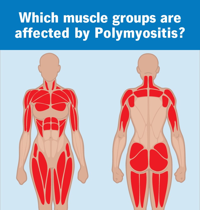 Polymyositis Symptoms