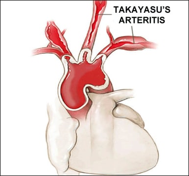 Takayasu's Arteritis Symptoms