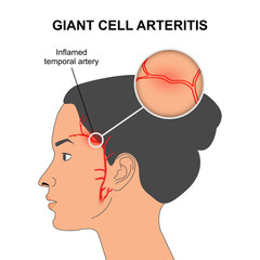Giant Cell Arteritis Symptoms