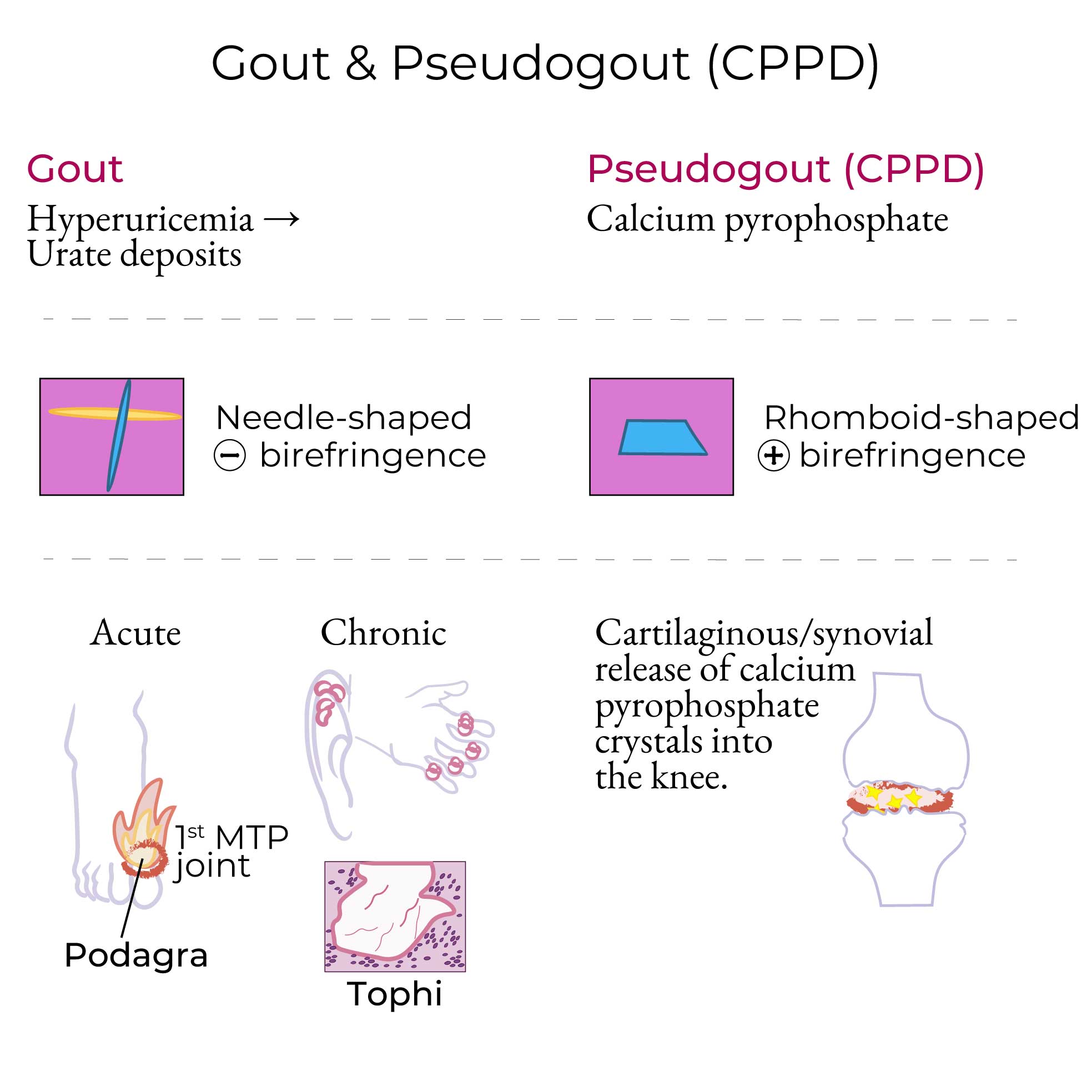 Gout and CPPD Symptoms