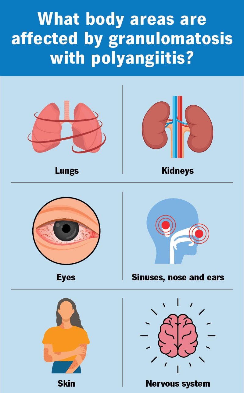 Wegener's Granulomatosis Symptoms