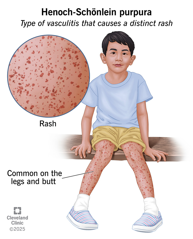 Henoch-Schonlein Purpura Symptoms