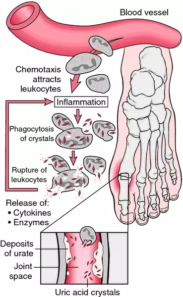 Metabolic Arthropathies Symptoms