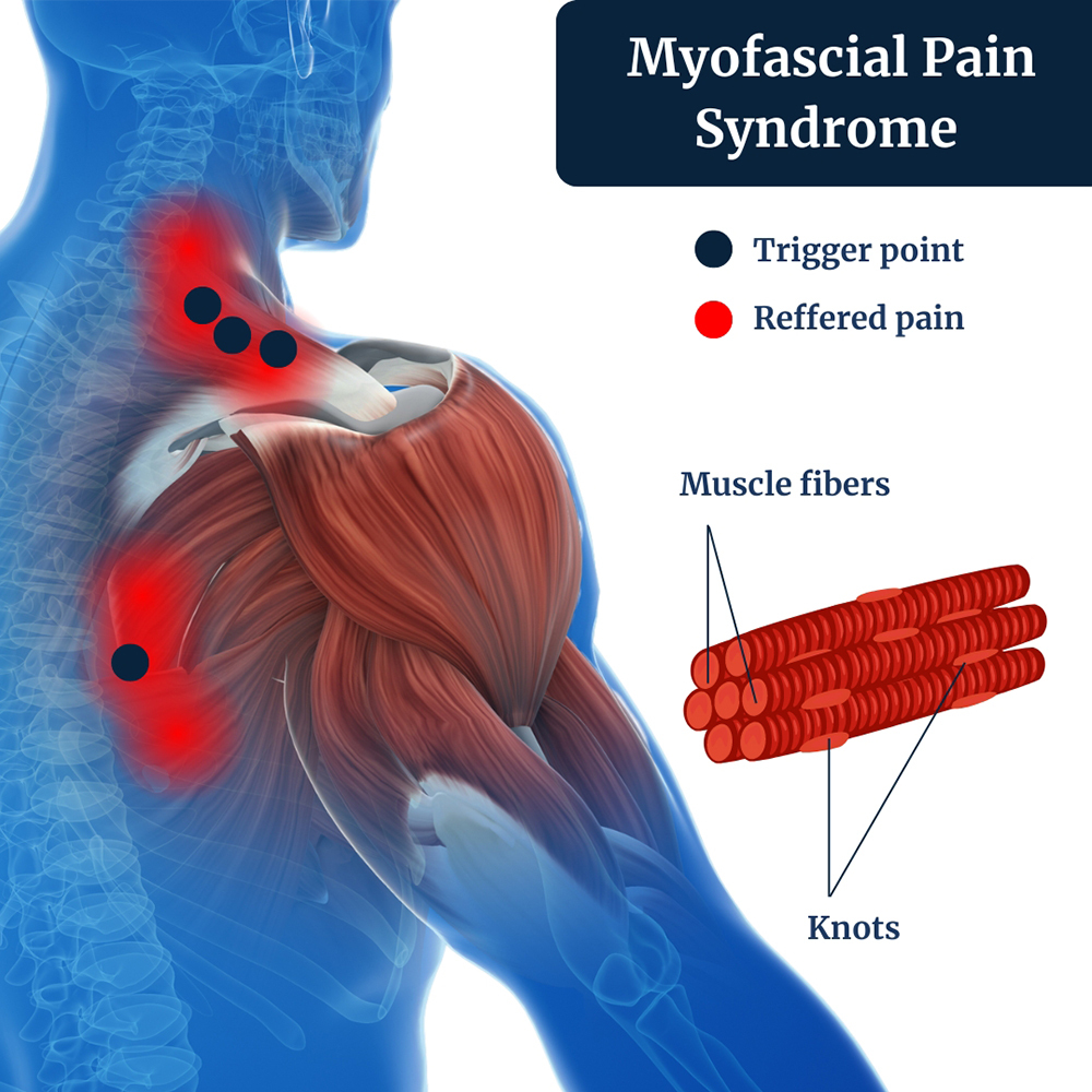 Myofascial Pain Syndromes Symptoms