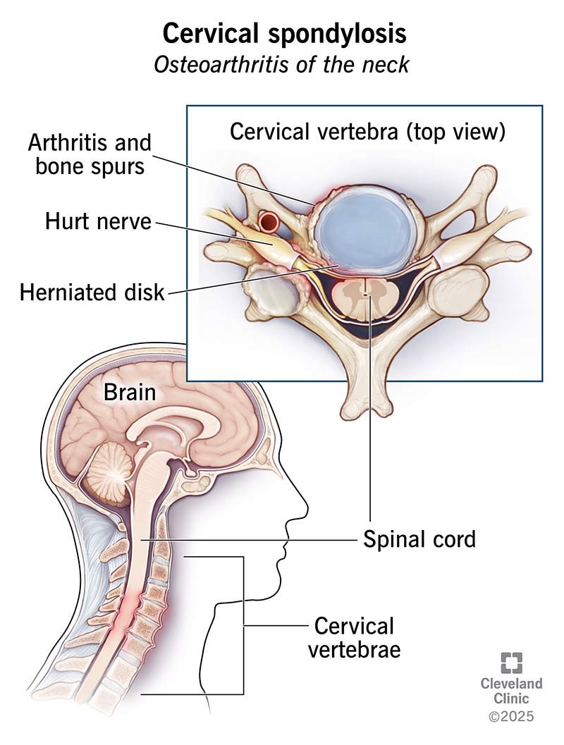 Cervical Spondylosis Symptoms
