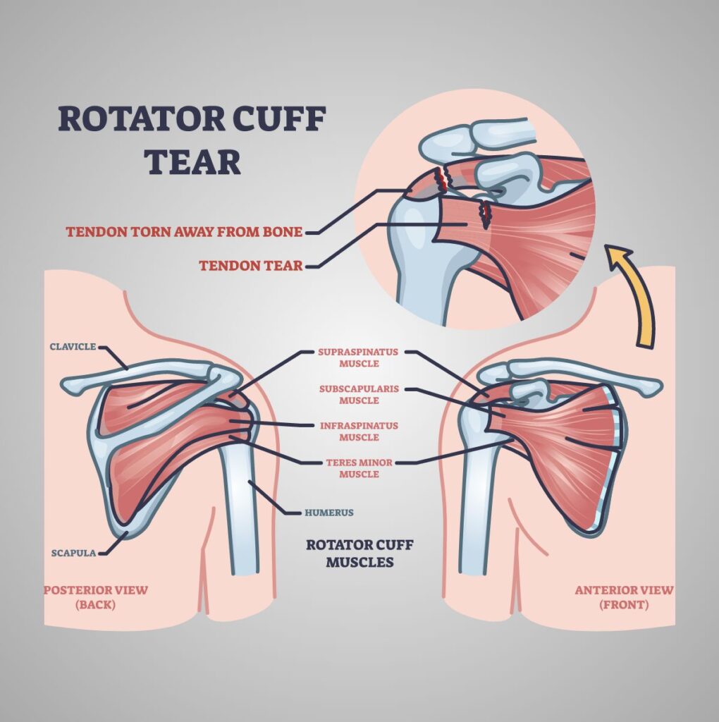 Rotator Cuff Tendinitis Symptoms