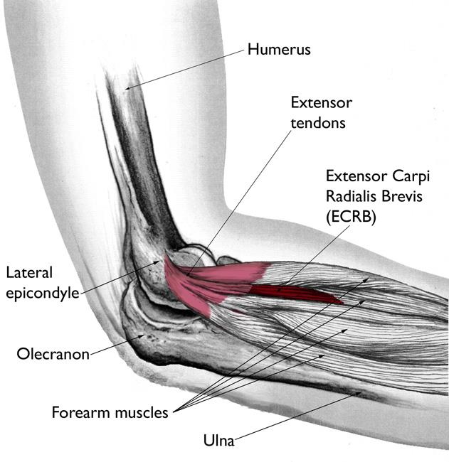 Lateral Epicondylitis Symptoms