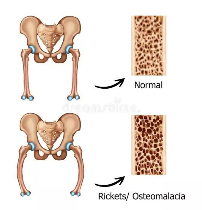 Osteomalacia Symptoms