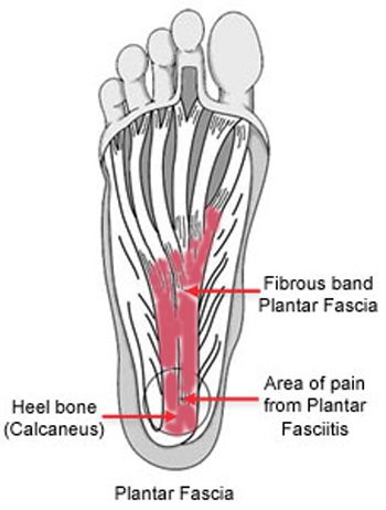 Plantar Fasciitis Symptoms