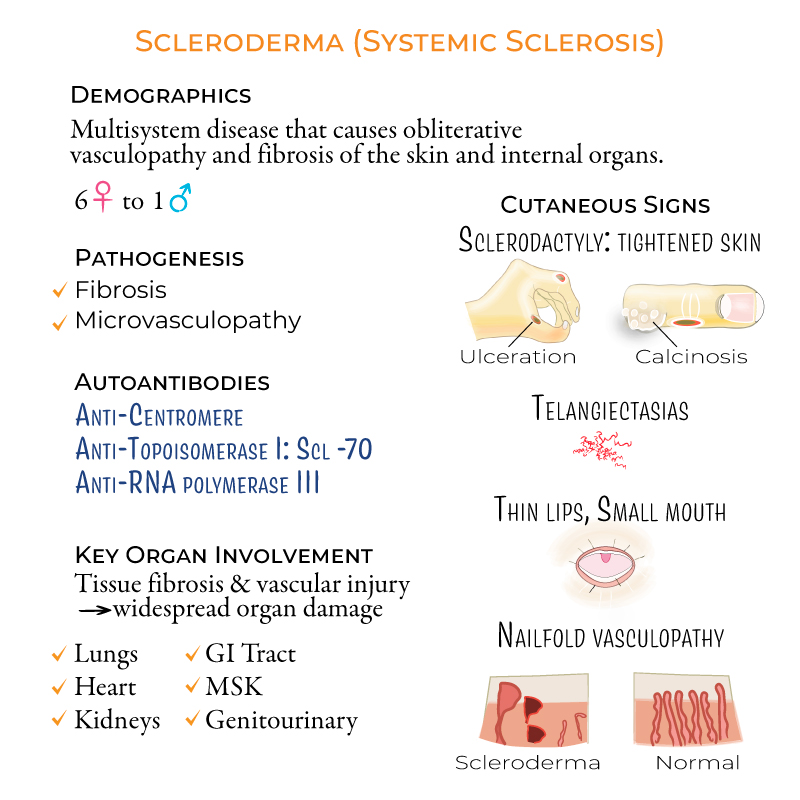 Systemic Sclerosis Symptoms